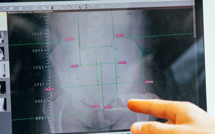 Radiografia della colonna sullo schermo, con le misurazioni